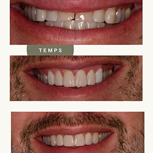 Nu-Art Before & After 1 (Dr. Megan Weisenberger)