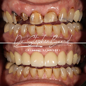 Nu-Art Before & After 3 (Dr. Stephen Brand)