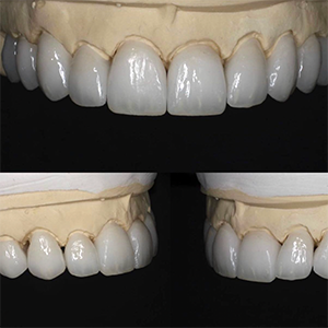 Nu-Art Veneers (lighter realistic shade)